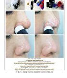 All Kill Blackhead Remover Stick - 10g