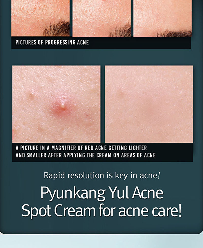 Acne Spot Cream - 15ml