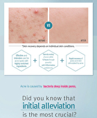 Acne Spot Cream - 15ml