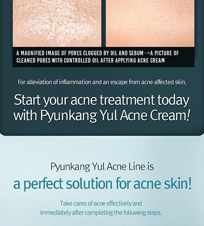Acne Cream - 50ml