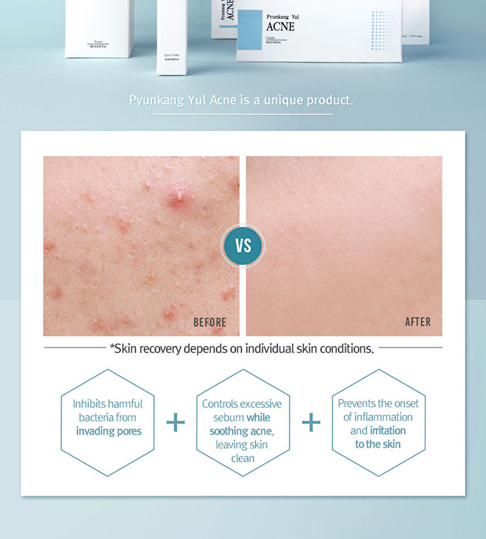 Acne Cream - 50ml