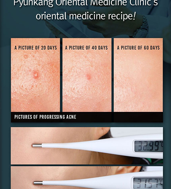 Acne Dressing Mask Pack - 18g x 1 sheet