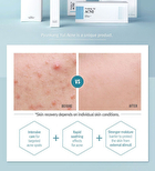 Acne Dressing Mask Pack - 18g x 1 sheet