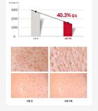 Nard Acne Clear Cleansing Foam - 150ml