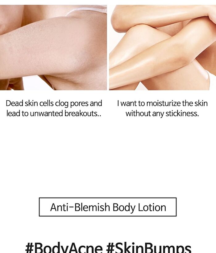 Tia\'m Anti Blemish Body Lotion Back & Chest - Renewed: 200ml