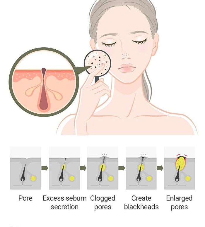 Daily Safe Black Head Clear Nose Pack Set - 11 pcs