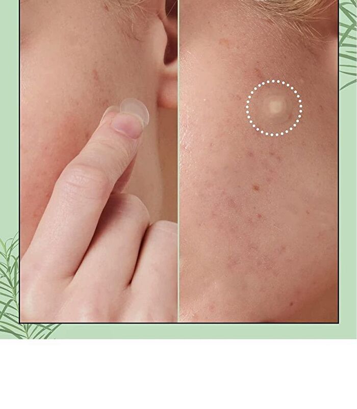I Dew Care Timeout Blemish Patch Original &  - 2 Types - Plus