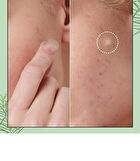 I Dew Care Timeout Blemish Patch Original &  - 2 Types - Plus