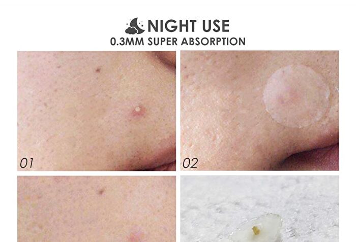 Focallure Acne Pimple Patch-Day & Night - #2 Night 24pcs