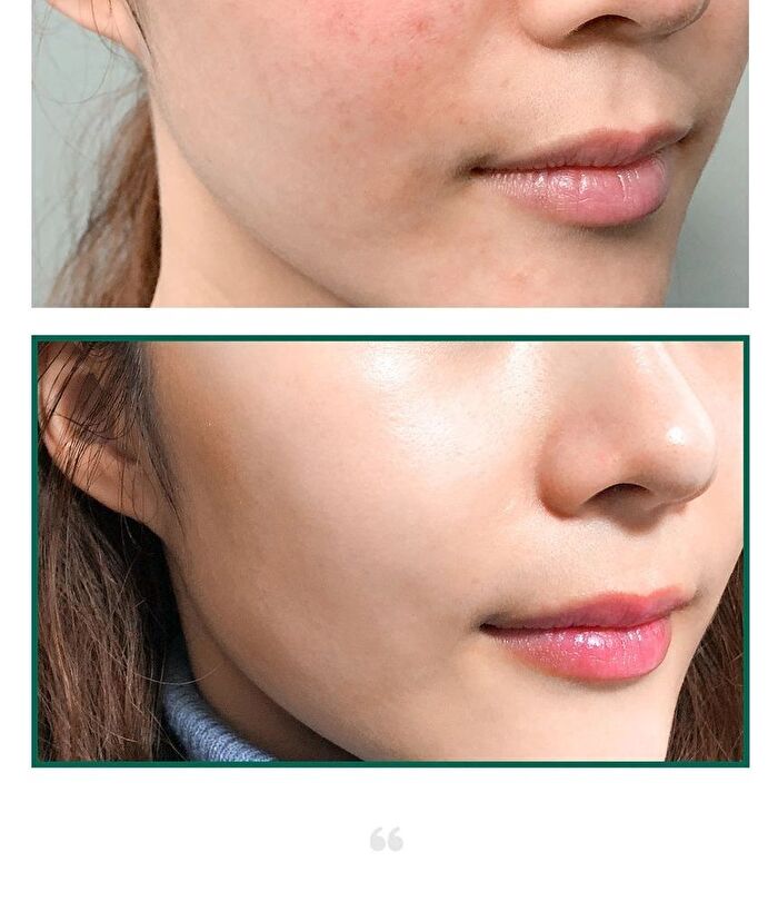 AHA,BHA,PHA 30 Days Miracle Acne Clear Foam Mini - 50ml