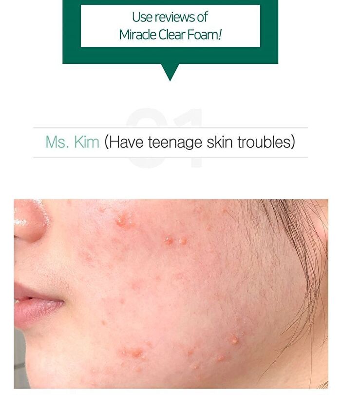 AHA,BHA,PHA 30 Days Miracle Acne Clear Foam Mini - 50ml