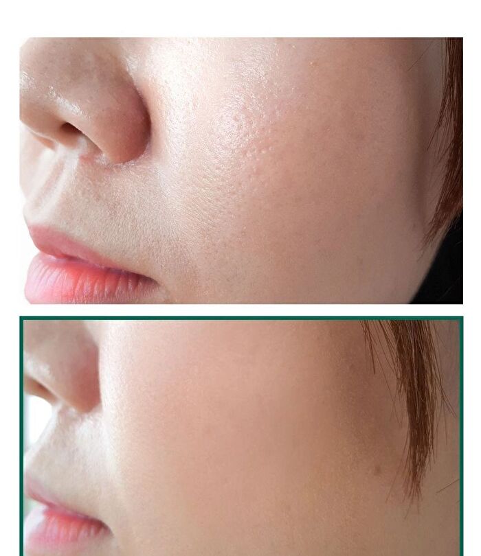 AHA,BHA,PHA 30 Days Miracle Acne Clear Foam Mini - 50ml