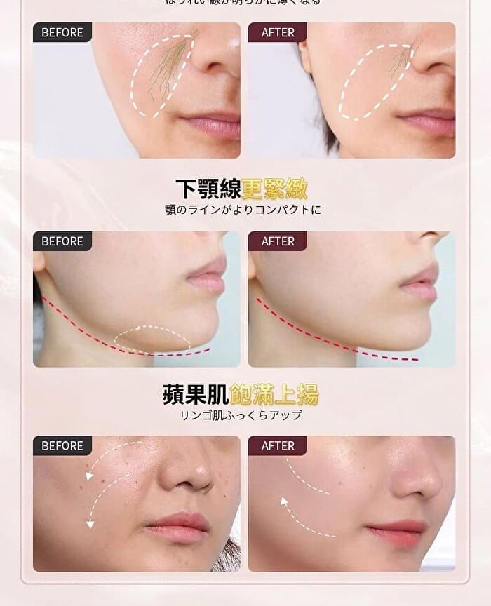 Collagen Revitalizing RF Device Pro - 1 Set