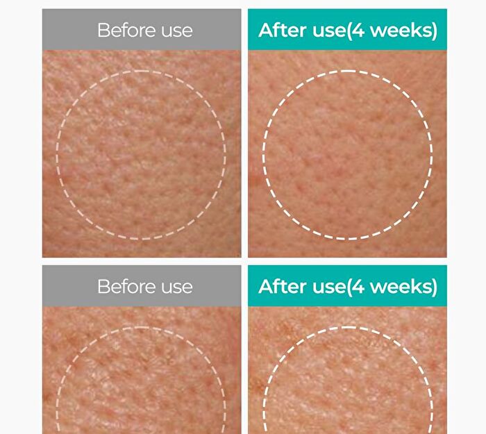 BP Pore Clear Facial Mask Set - 25ml x 5 pcs