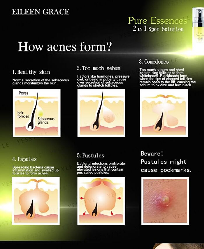 Eileen Grace Acne Prevent Essences - 30ml
