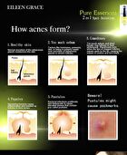 Eileen Grace Acne Prevent Essences - 30ml