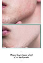 AHA, BHA, PHA 30 Days Miracle Serum 50ml - 2024 Version - 50ml