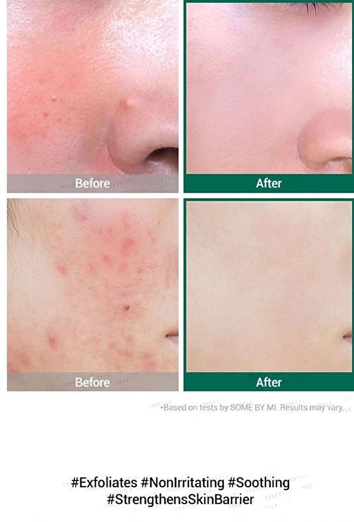 AHA, BHA, PHA 30 Days Miracle Serum 50ml - 2024 Version - 50ml