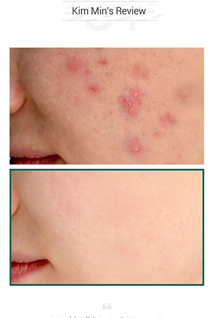 AHA, BHA, PHA 30 Days Miracle Serum 50ml - 2024 Version - 50ml