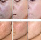 Sightfuture SymWhite 377 Skin Genesis Spot Whitening Cream - 30g