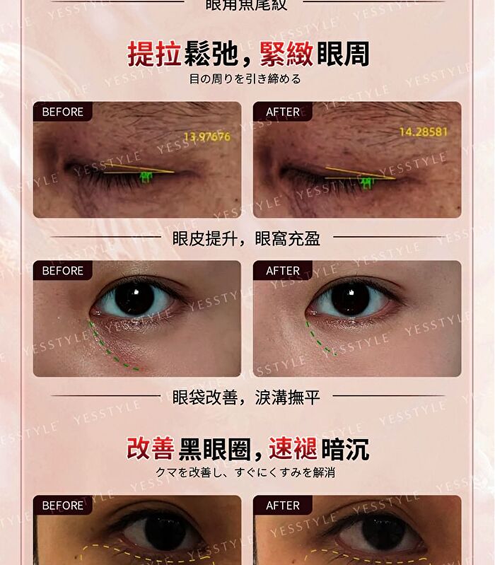 Dual-Probe Full Effect Periocular Anti-Aging RF Eye Massager Pro 4.0 - 1 set