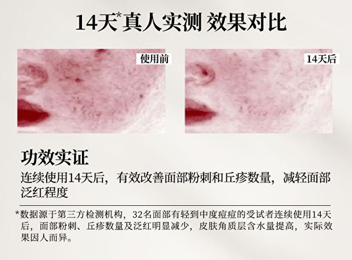 Tea Tree Anti-Acne Mask Set - Set (5pcs)