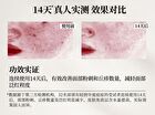 Tea Tree Anti-Acne Mask Set - Set (5pcs)