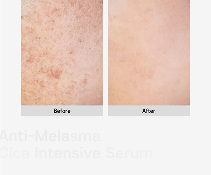Anti-Melasma Cica Intensive Serum - 30ml