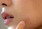 Nard Serum - 3 Types - Tea Tree Blemish Calming