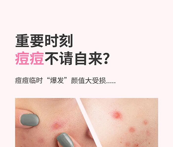 Yaozhi Cute Radiance Acne Pimple Patch (Trial Size)  - 3 Types - Rest Time (12pcs)