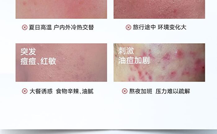 Redness Relief & Acne Removal Essence - Set (1.5ml x 30pcs)