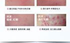 Redness Relief & Acne Removal Essence - Set (1.5ml x 30pcs)