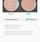 Pore-Thera Shot Minimizer - 1 set