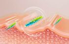 Pore-Thera Shot Minimizer - 1 set