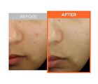 a. solution Acne Clear Toner Pad - 60 pads