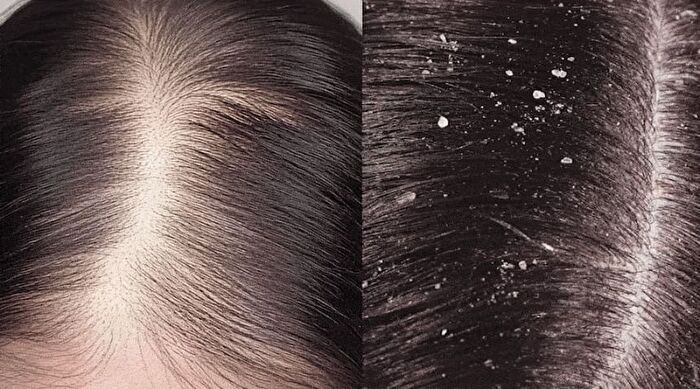 Therapy Scalp Scaling Scrub - 200g