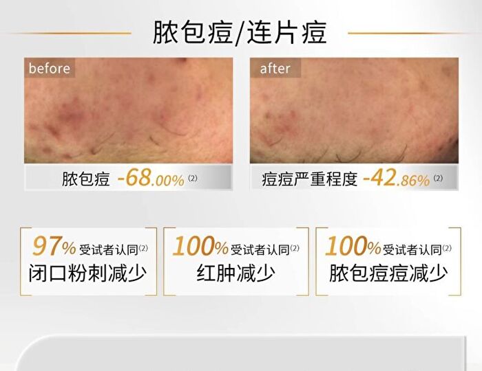 Lactobionic Acid Oil Control Astringent Mask - 25g x 5pcs