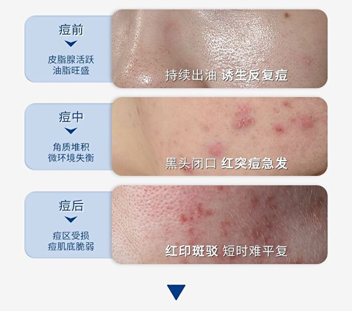 Acne Cleansing Essence - Set (1.5ml x 30pcs)