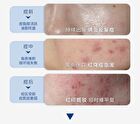 Acne Cleansing Essence - Set (1.5ml x 30pcs)