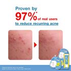 Peptide Acne Gel - 9g