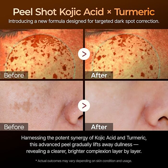 Peel Shot Exfoliating Kojic Acid Turmeric Serum - 80ml