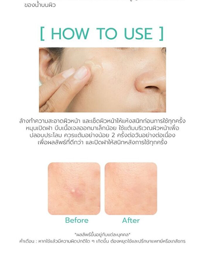 Anti Acne Gel - 15g