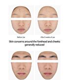 Acne Shot Ampoule  - 2025 Version - 30ml
