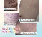 Sadoer Panda Hydrocolloid Acne Patch - 40pcs