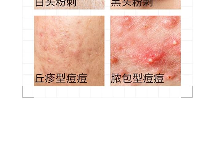 2% Salicylic Acid Jelly Mask - 2 Types - 100g