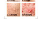 2% Salicylic Acid Jelly Mask - 2 Types - 100g