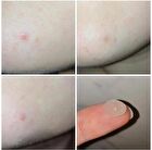 Shield Pimple Patches - 1 pack x 54 patches