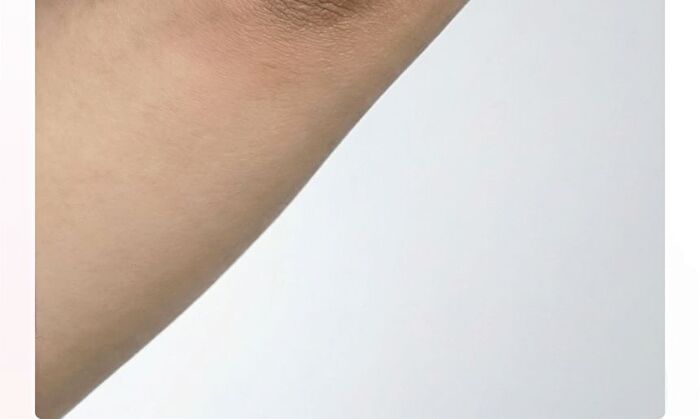 Active Urea Lactic Acid 73000 Cream - 20g