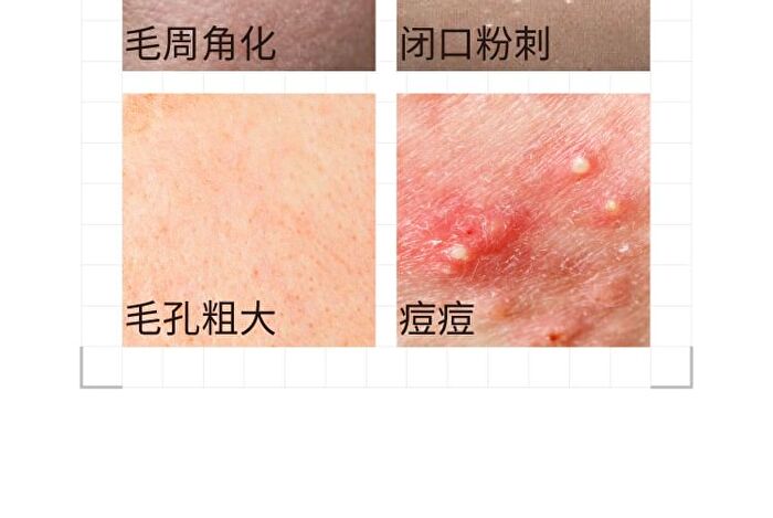 5% Mandelic Acid Serum - 2 Types - 30ml