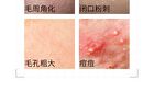 5% Mandelic Acid Serum - 2 Types - 30ml